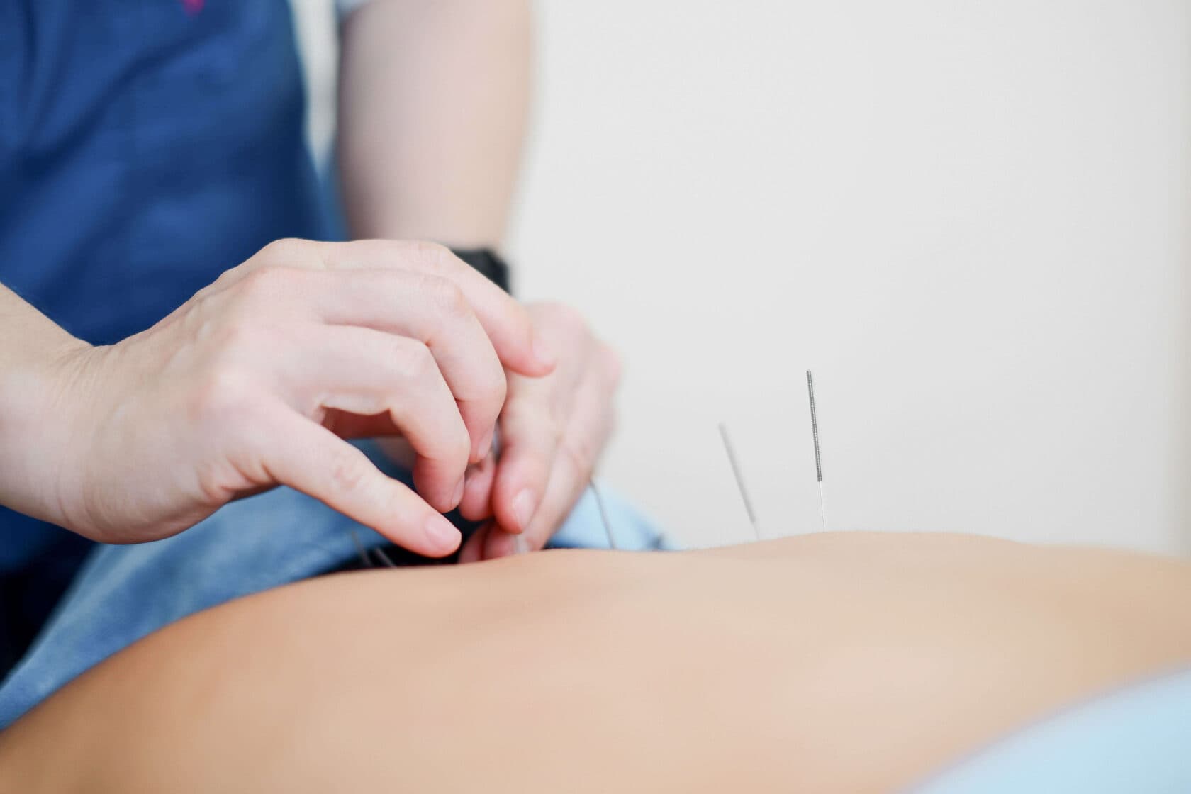 Acupuncture
